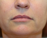 Feel Beautiful - Restylane Defyne Lip Enlargement - Before Photo